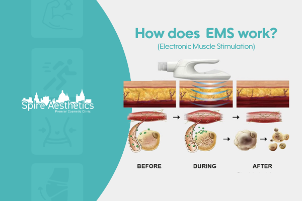 EMS treatment for post pregnancy weight loss treatment Halstead