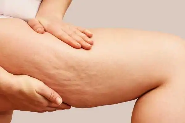 Image of woman showing leg with cellulite Halstead