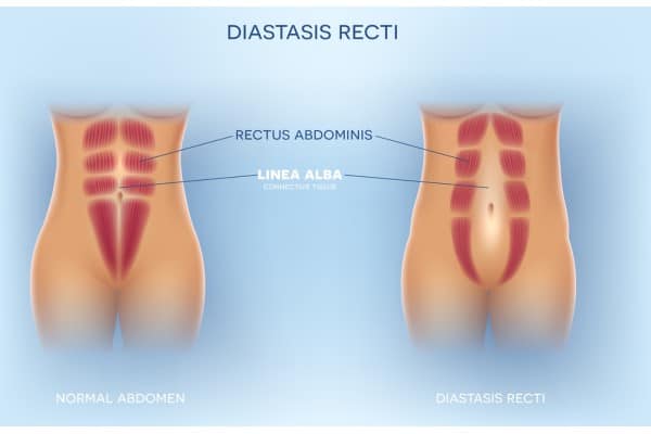 What Non-Surgical Options Are Available for Diastasis Recti Halstead?