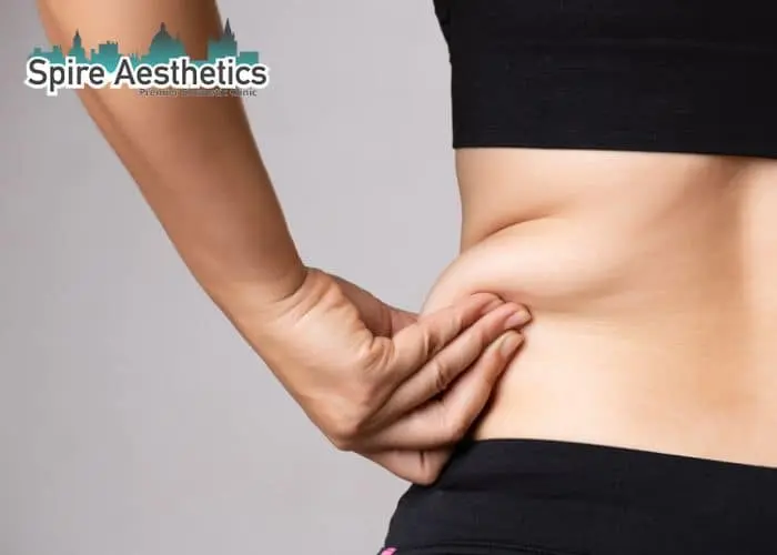 Image of woman pinching fat on their hips Halstead. Fat Freezing treatment