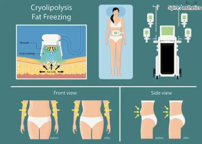 Fat freezing treatment Halstead benefits for competitions to remove stubborn fat deposits.