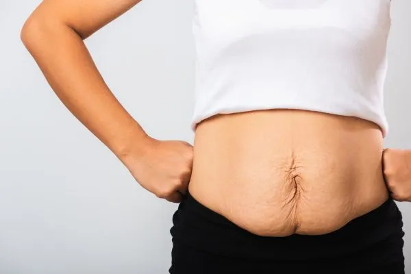 Image of a woman's stomach after weight loss with sagging skin following a gastric band Halstead