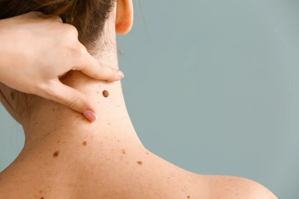skin blemish removal Halstead treatment