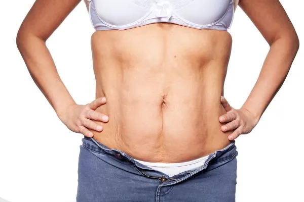sagging skin on woman's stomach after weight loss injections Halstead