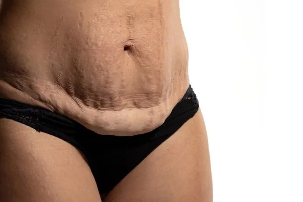 Image of womans stomach after weight loss injections Halstead showing saggy skin