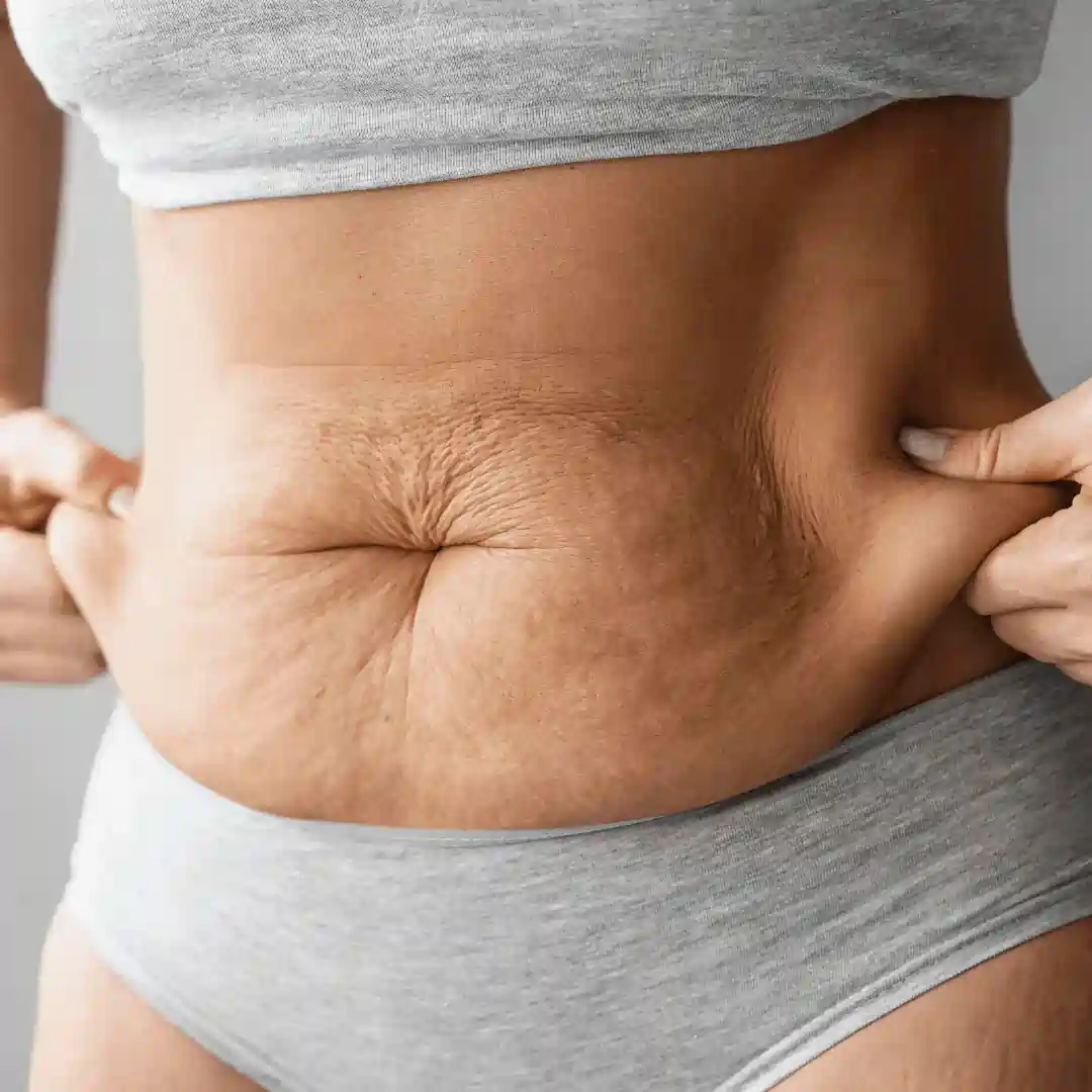 Is It Normal to Have Loose Skin After Pregnancy Halstead?