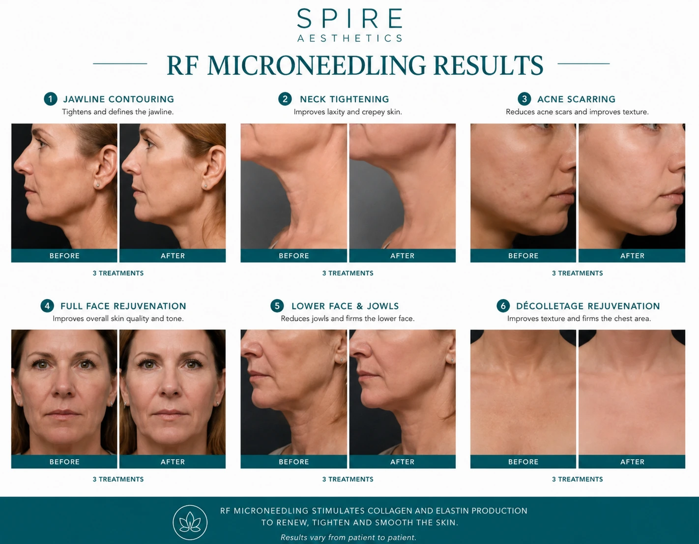 RF Microneedling Skin tightening Halstead results