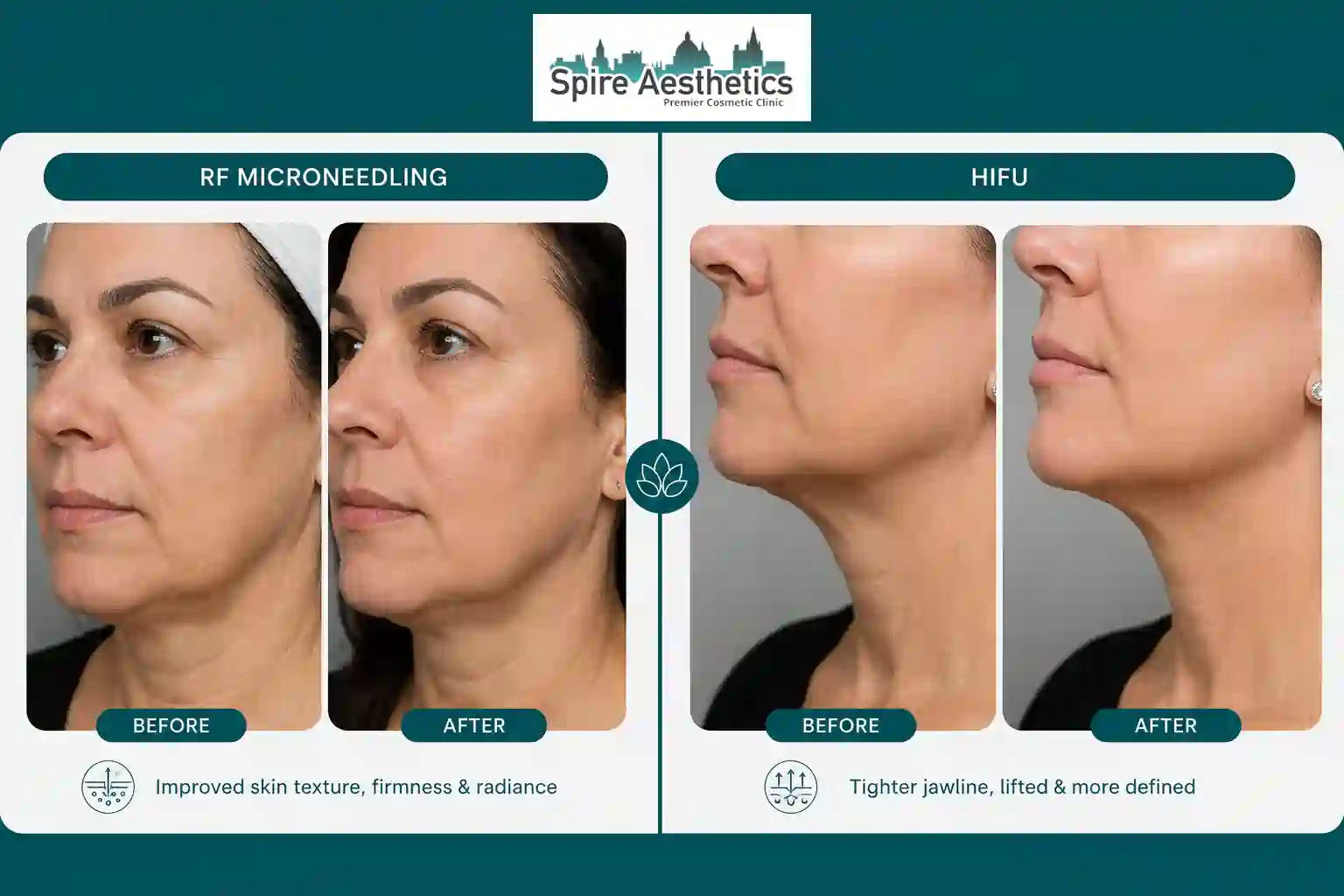 Can RF Microneedling and HIFU Be Combined Halstead?