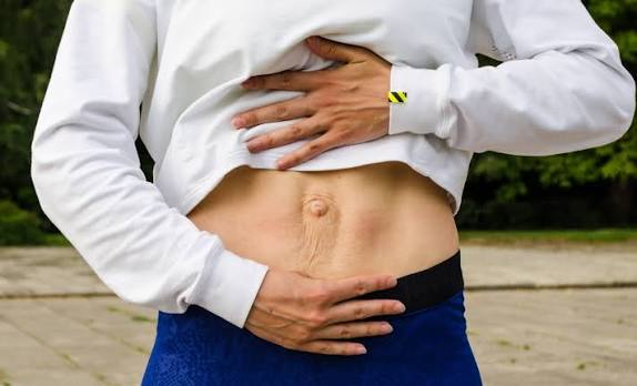 When Could Diastasis Recti Be the Missing Piece of the Puzzle Halstead?